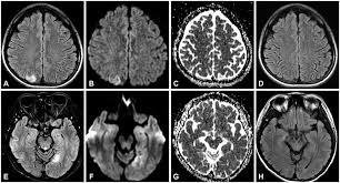 Stroke: The Sudden Striker (image credits: wikimedia)