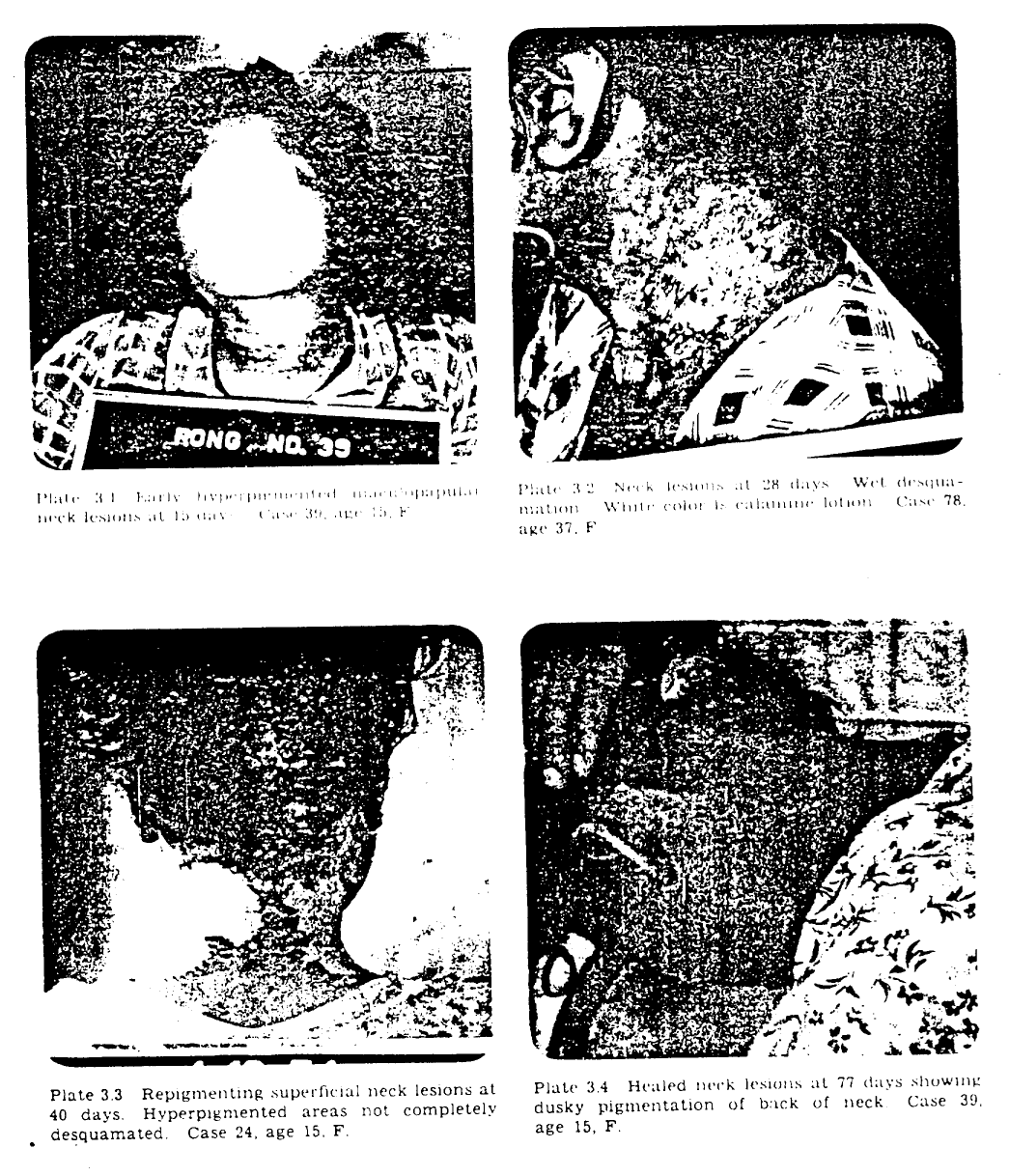 Project 4.1 (1954): Unconsented Radiation Experiments (image credits: wikimedia)