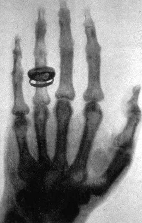 X-rays – Wilhelm Röntgen (1895) (image credits: wikimedia)